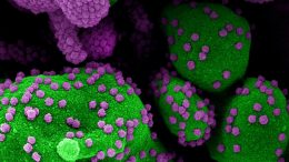 凋亡细胞严重感染SARS-COV-2病毒颗粒