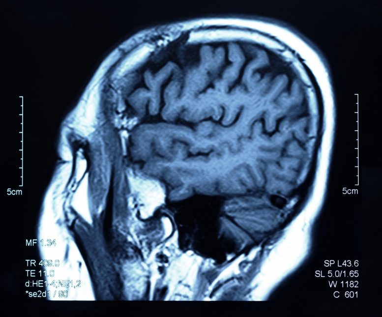 脑扫描MRI捕获