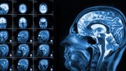 脑部扫描显示多动症是一系列不同的疾病