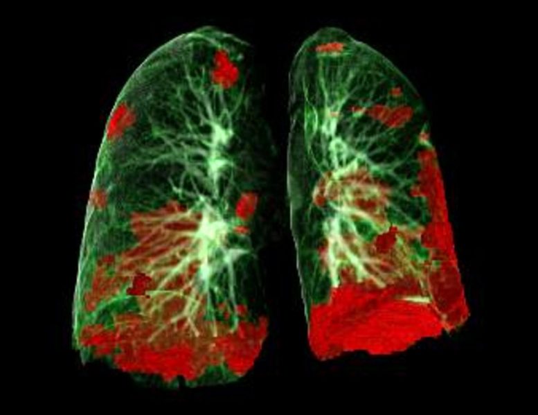 COVID-19患者肺损害