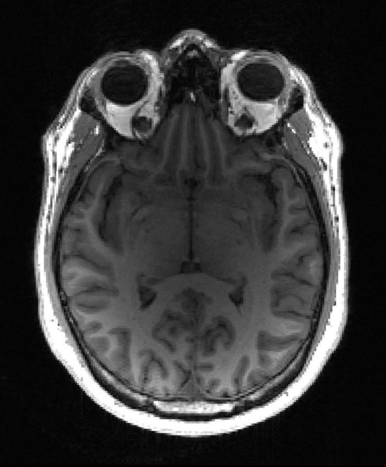健康的MRI脑部扫描