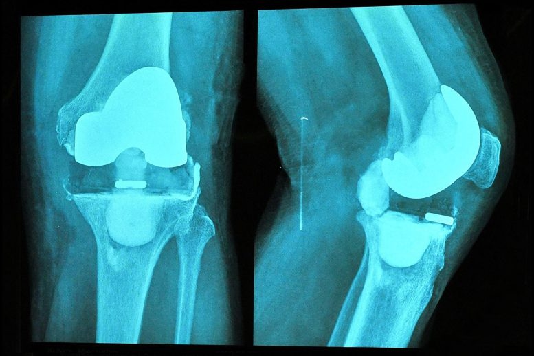 膝关节置换手术X线片