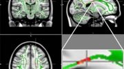 MRI反射Operse Teens脑损伤