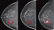 机器学习可以从乳房x光照片中预测癌症风险