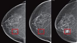机器学习预测乳房图像图像的癌症风险