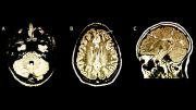 研究人员发现使用MRI脑扫描的儿童的MS风险