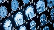 研究人员识别帕金森病的脑干变化