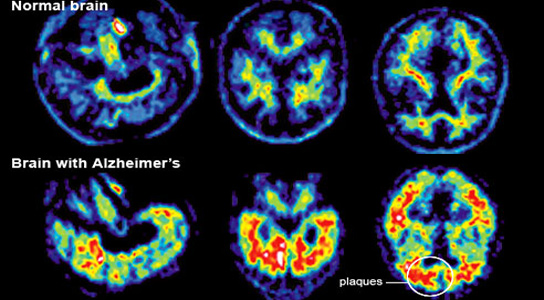 brain-with-alzheimer-without