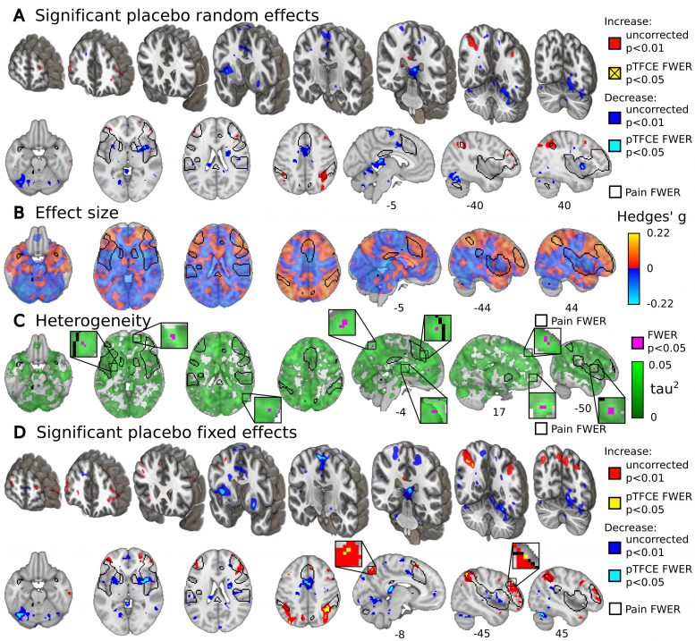 fMRI活动安慰剂效应