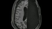 一个大脑半球被切除的成人的fMRI扫描