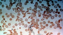 微流化设备可分析镰状细胞疾病病人血样行为
